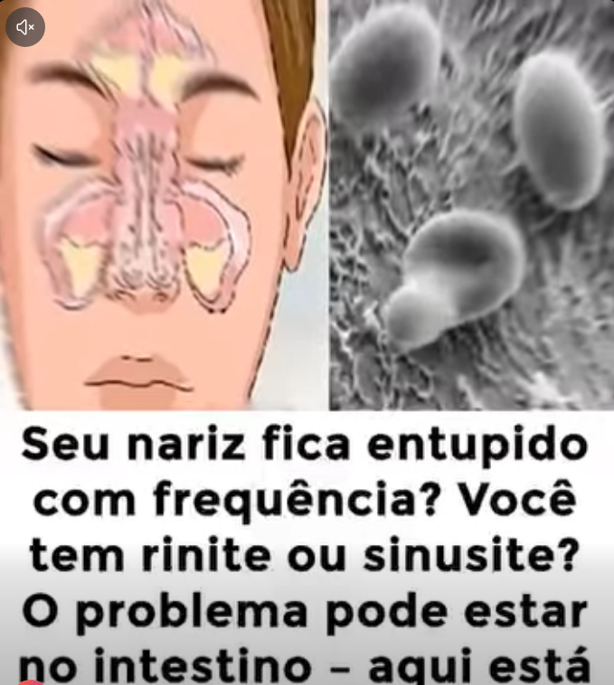Nariz Entupido