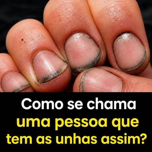 Como se chama uma pessoa que tem as unhas assim?