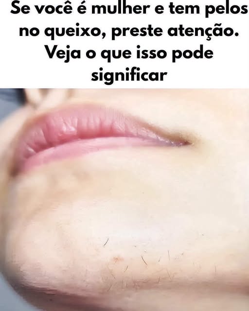 Pelos no queixo em mulheres: o que isso significa?