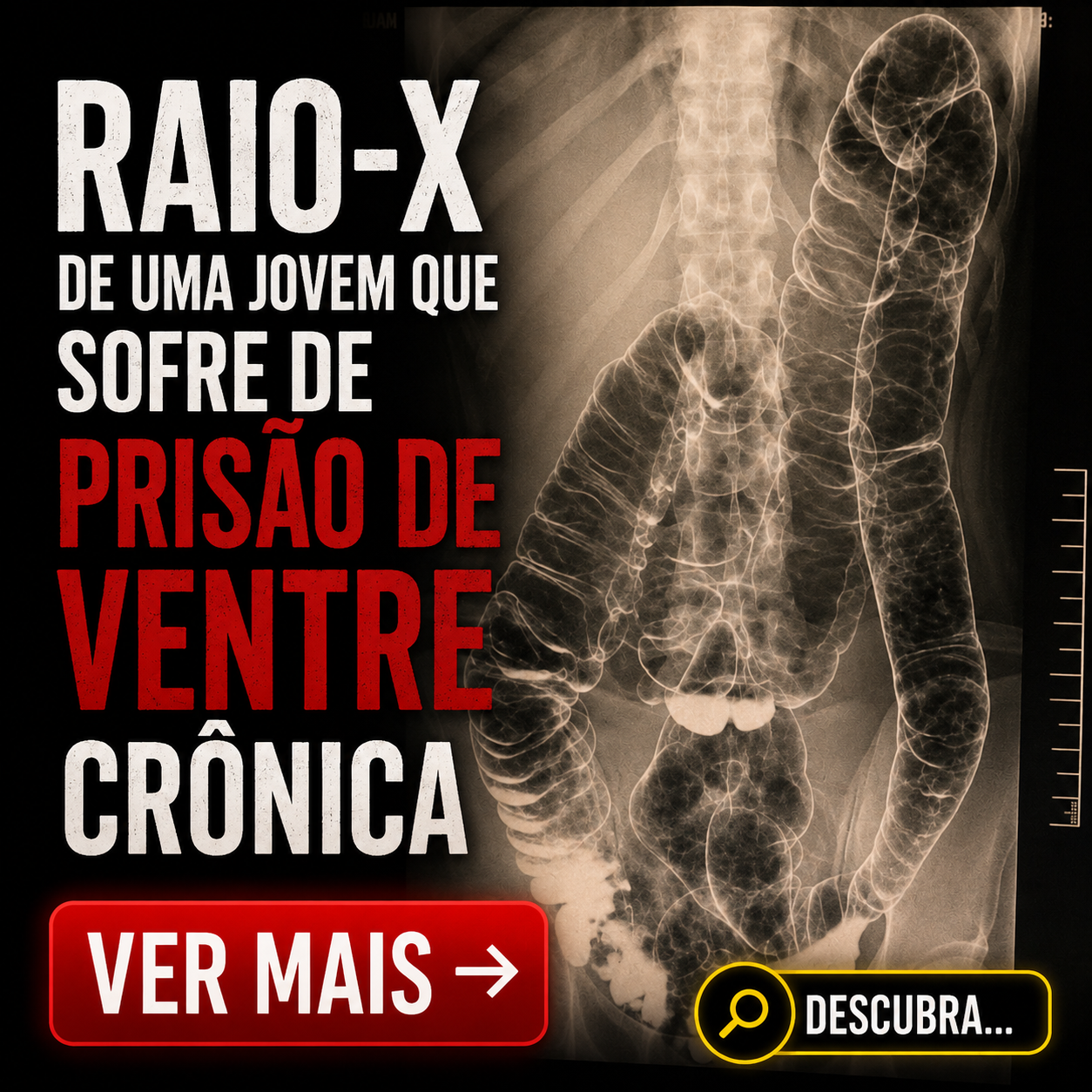 Cólon Saturado