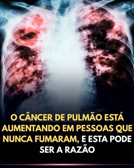 Câncer de pulmão em não fumantes: entenda os motivos